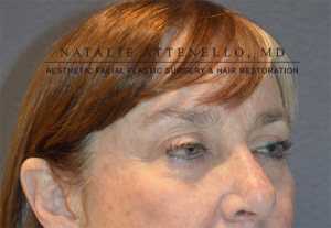 Blepharoplasty Case 3606 Before Photo Blepharoplasty