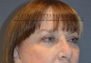 Blepharoplasty Case 3606 After Photo Blepharoplasty