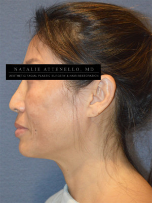 Facelift Case 3642 Before Photo Facelift