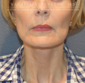 Facelift Case 3680 After Photo Facelift