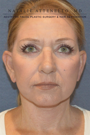 Facelift Case 3691 After Photo Facelift