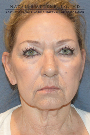 Facelift Case 3691 Before Photo Facelift