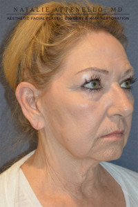 Dr. Attenello Patient 3/4 profile close-up before facelift