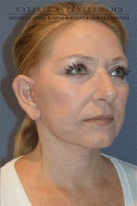 Dr. Attenello Patient 3/4 profile close-up after facelift