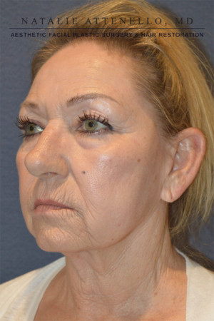 Facelift Case 3691 Before Photo Facelift