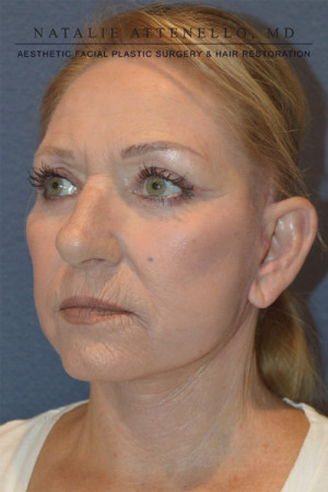Facelift Case 3691 After Photo Facelift