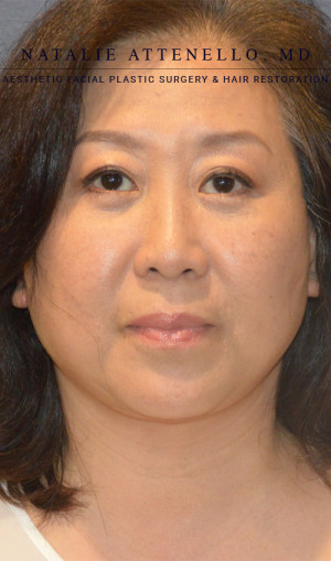 Facelift Case 3701 After Photo Facelift