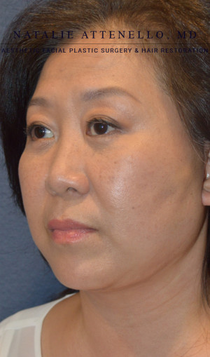 Facelift Case 3701 After Photo Facelift
