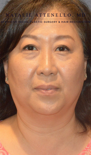 Facelift Case 3701 Before Photo Facelift