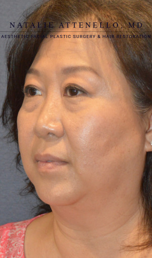 Facelift Case 3701 Before Photo Facelift