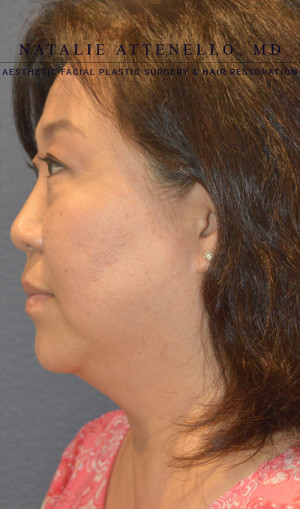 Facelift Case 3701 Before Photo Facelift