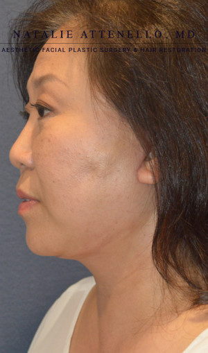 Facelift Case 3701 After Photo Facelift