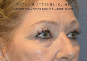 Blepharoplasty Case 3713 Before Photo Blepharoplasty
