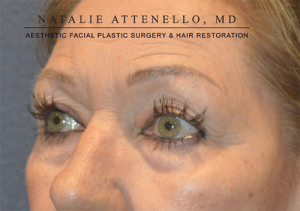 Blepharoplasty Case 3713 Before Photo Blepharoplasty