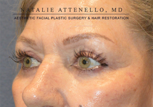 Blepharoplasty Case 3713 After Photo Blepharoplasty