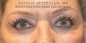 Blepharoplasty Case 3713 After Photo Blepharoplasty