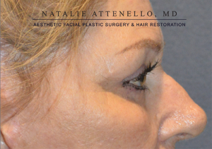 Blepharoplasty Case 3713 After Photo Blepharoplasty