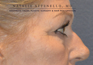 Blepharoplasty Case 3713 Before Photo Blepharoplasty