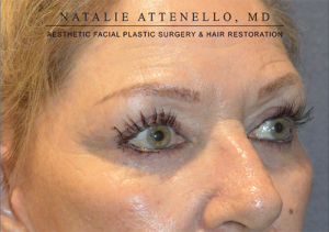 Blepharoplasty Case 3713 After Photo Blepharoplasty