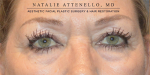 Blepharoplasty