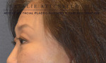 Blepharoplasty