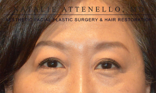 Blepharoplasty