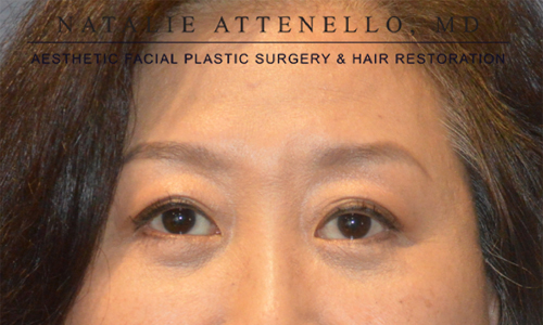 Blepharoplasty