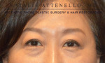 Blepharoplasty