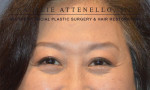 Blepharoplasty