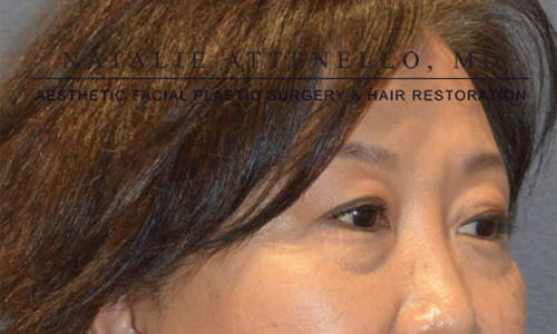 Blepharoplasty