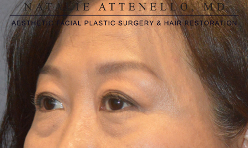 Blepharoplasty