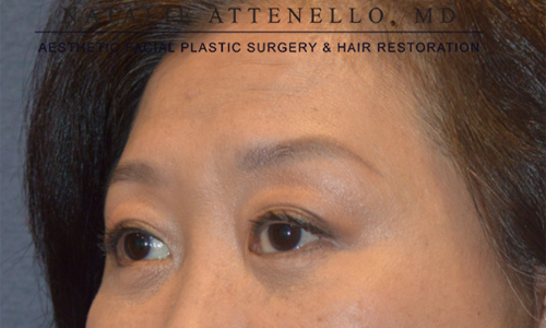 Blepharoplasty