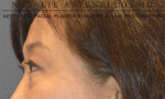 Blepharoplasty