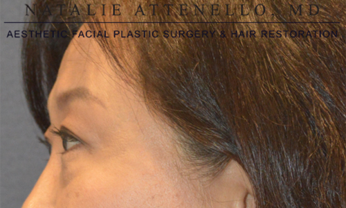 Blepharoplasty