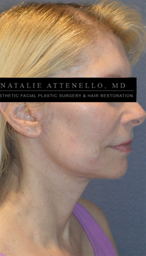 Facelift Case 3768 After Photo Facelift