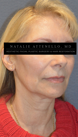Facelift Case 3768 Before Photo Facelift