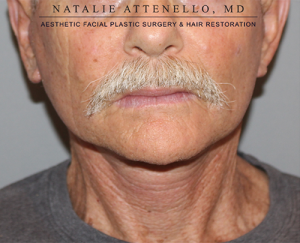 Facelift Case 3769 After Photo Facelift