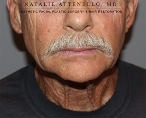 Facelift Case 3769 Before Photo Facelift