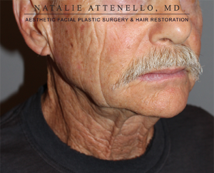 Facelift Case 3769 Before Photo Facelift
