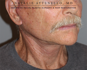 Facelift Case 3769 After Photo Facelift