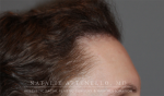 Hairline Lowering/Forehead Reduction