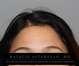 Close up view of patient's forehead after forehead reduction surgery by Dr. Natalie Attenello