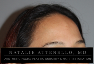 Patient's forehead before hairline lowering surgery by Dr. Natalie Attenello