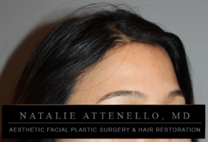 Final results of forehead reduction surgery done by Dr. Natalie Attenello in Beverly Hills, CA