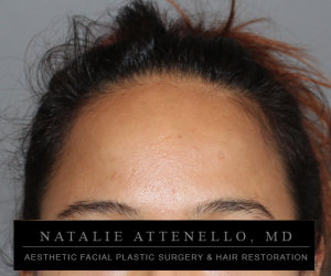 Close up view of patient's forehead before forehead reduction surgery by Dr. Natalie Attenello in Beverly Hills