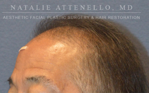 Hair Restoration Case 3815 Before Photo Hair Restoration