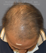 Hair Restoration