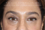 Blepharoplasty