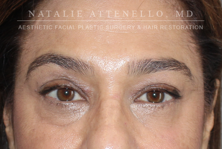 Blepharoplasty