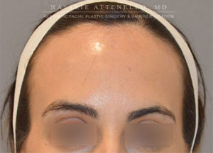 Before picture of patient who underwent forehead reduction surgery by Dr. Natlie Attenello